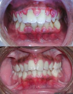 Gingivitis Before and After Cleaning