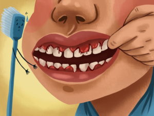 gingivitis_bleeding_gums_NOT_Best_Dental_Flosser