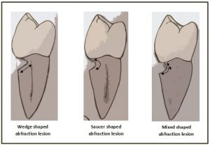 Abfraction_lesion_sensitive teeth from grinding