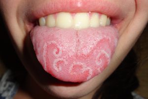 Geographic_tongue_How To Remove Plaque From Tongue