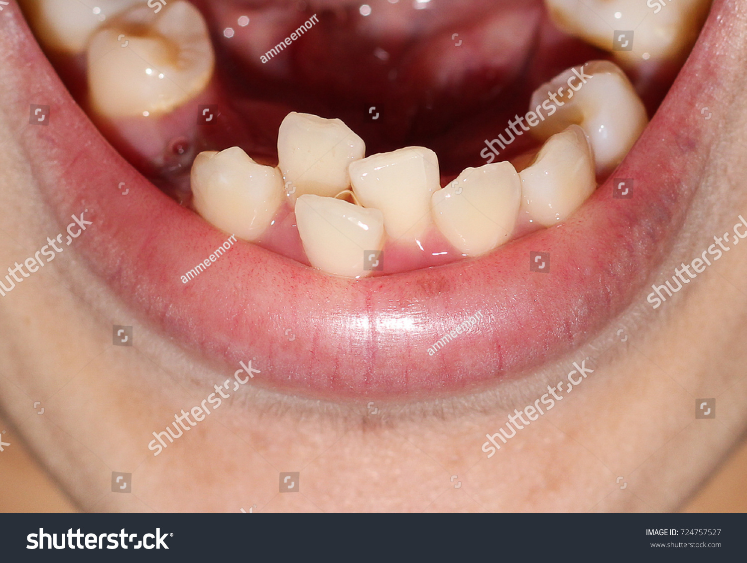 Are You Noticing Shifting Teeth After Invisalign ? - Dental Products Guy